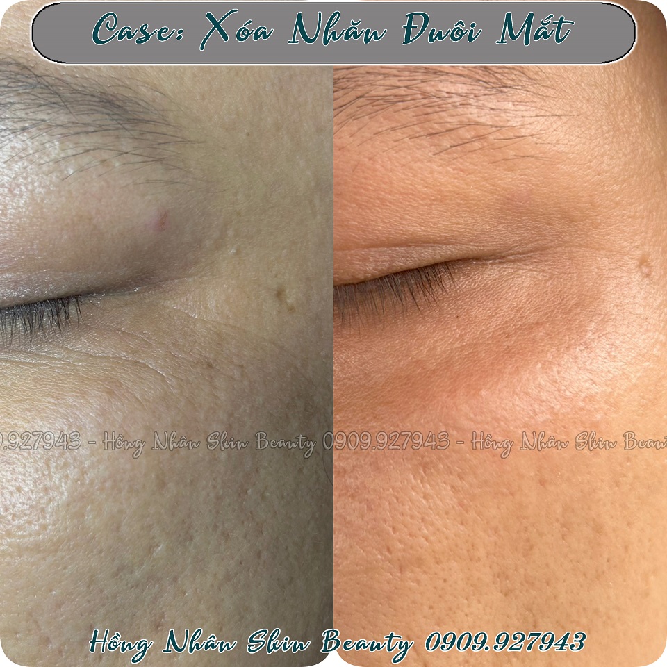 xoa nhan hns